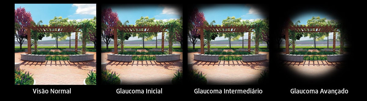 glaucoma como a pessoa ve