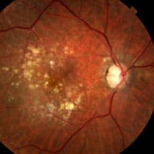 Doença macular relacionada a idade